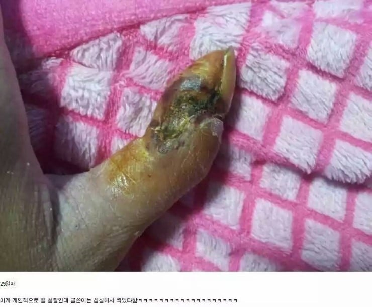 쇠살모사 물린 손가락 치유과정.jpg (혐오주의) | 인스티즈