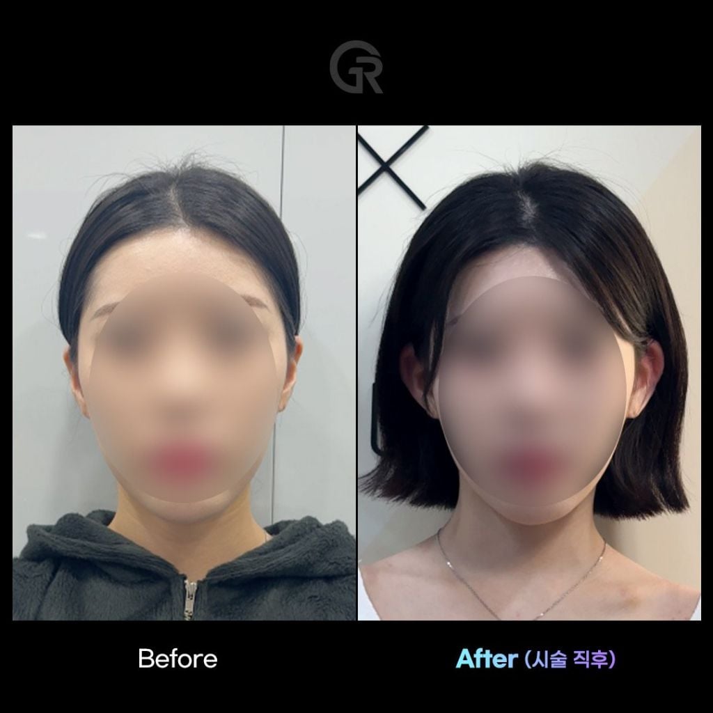 요즘 유행하는 귀 필러 시술 | 인스티즈