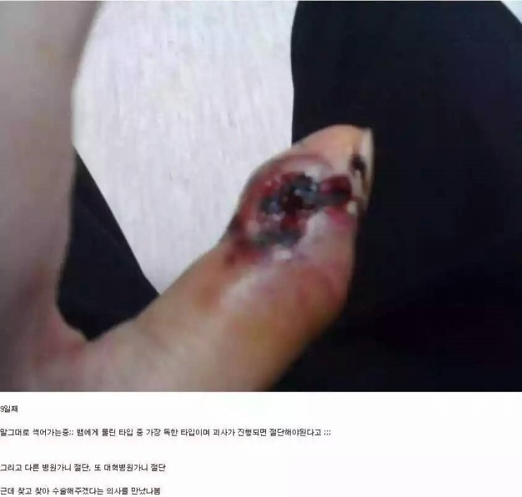 쇠살모사 물린 손가락 치유과정.jpg (혐오주의) | 인스티즈