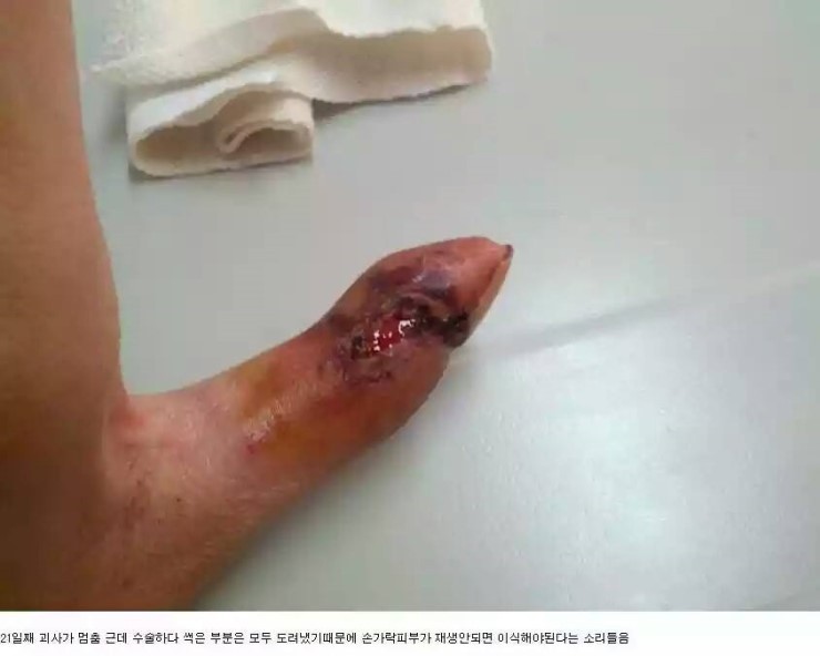 쇠살모사 물린 손가락 치유과정.jpg (혐오주의) | 인스티즈