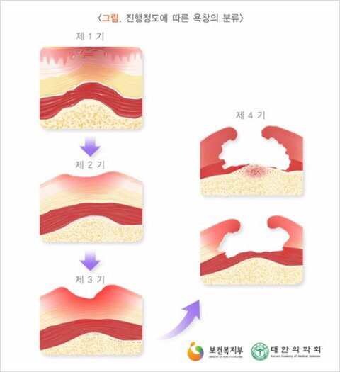 일상생활장해가 있는 환자들이 가장 무서워하는 질병...(많이 충격적일수있으니까 주의하세요) | 인스티즈