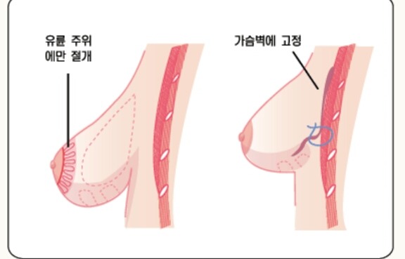 유방 하수(쳐진 가슴) 수술법.jpg | 인스티즈
