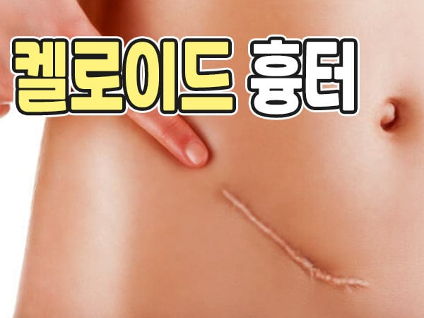 출산의 현실(무통주사, 자연분만, 제왕절개) | 인스티즈