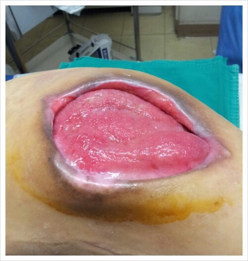 일상생활장해가 있는 환자들이 가장 무서워하는 질병...(많이 충격적일수있으니까 주의하세요) | 인스티즈