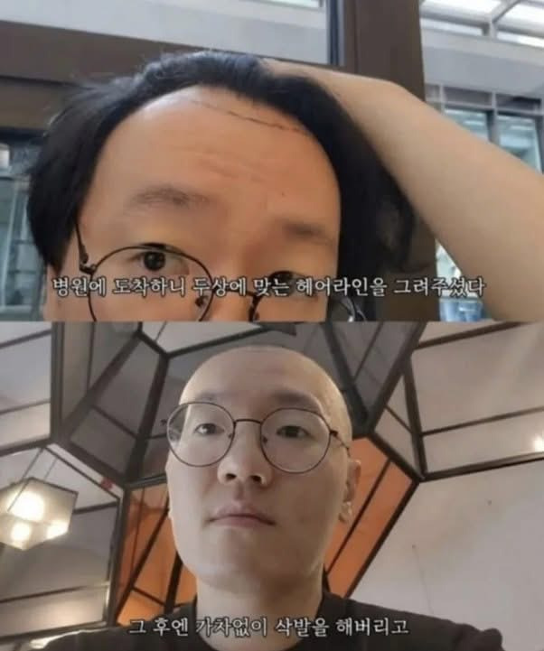 터키로 모발 이식 하러 간 사람에게 일어난 일 | 인스티즈