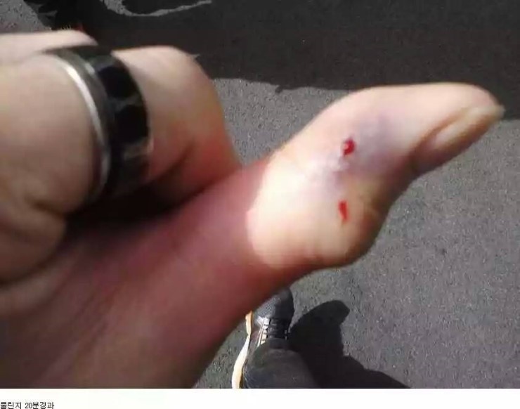 쇠살모사 물린 손가락 치유과정.jpg (혐오주의) | 인스티즈
