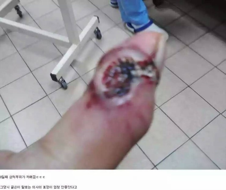 쇠살모사 물린 손가락 치유과정.jpg (혐오주의) | 인스티즈