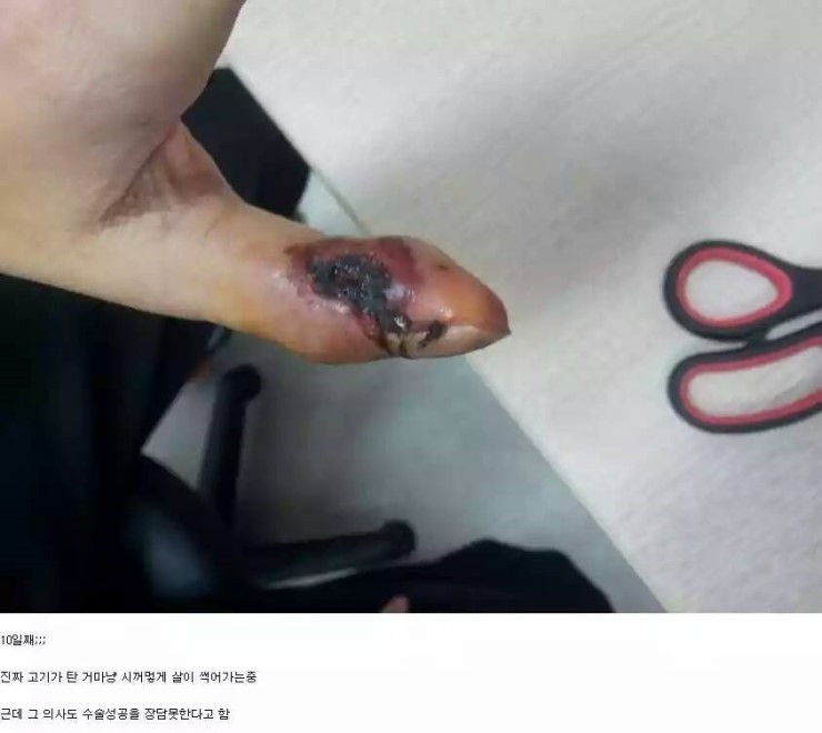 쇠살모사 물린 손가락 치유과정.jpg (혐오주의) | 인스티즈