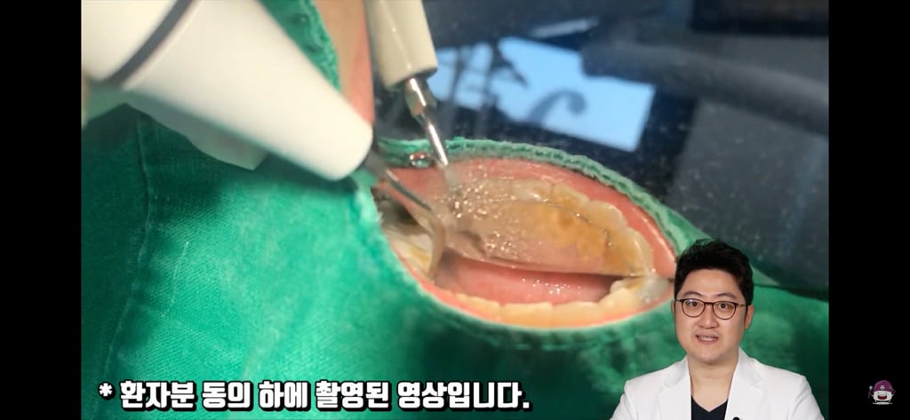 스케일링 꾸준히 해야하는 이유.jpgif | 인스티즈