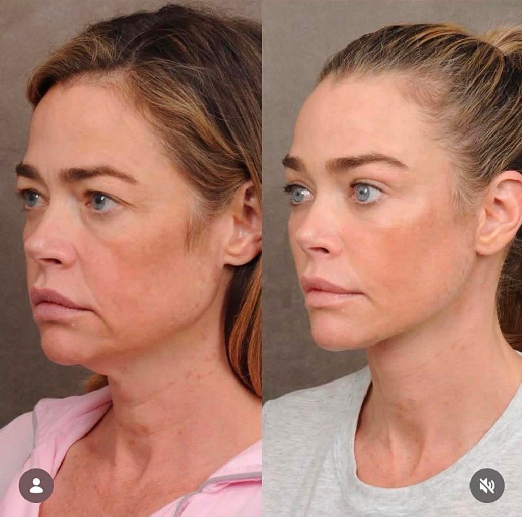 안면리프팅 한 배우 데니스 리차드 | 인스티즈