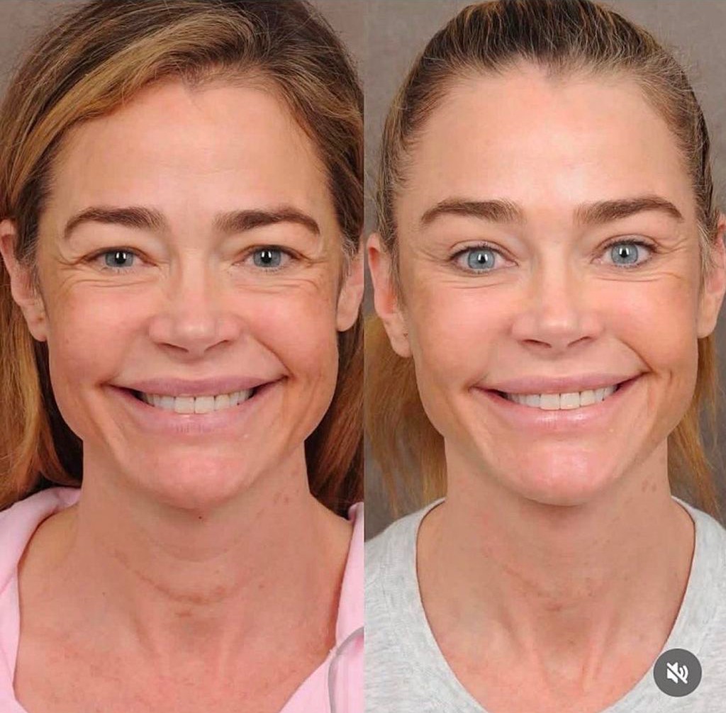 안면리프팅 한 배우 데니스 리차드 | 인스티즈