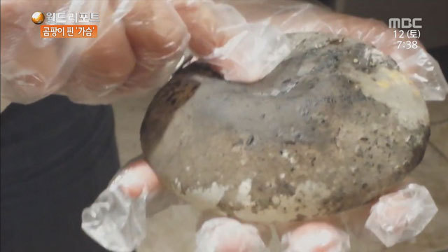 성형외과 종사자들이 말하는 부작용 위험높은 수술 쓰리톱 (혐오주의) | 인스티즈