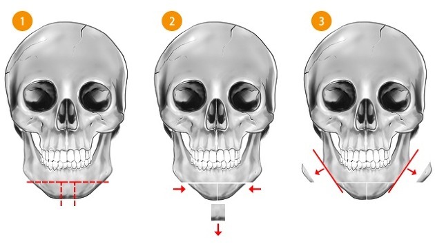 턱수술과 양악수술의 차이.gif | 인스티즈