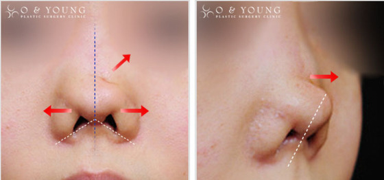 성형외과 종사자들이 말하는 부작용 위험높은 수술 쓰리톱 (혐오주의) | 인스티즈