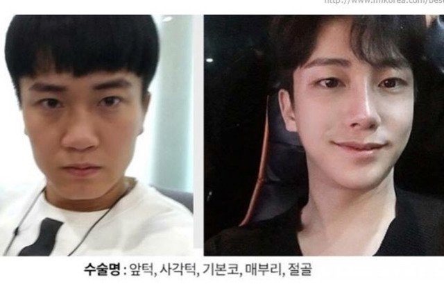 남자 성형전후 | 인스티즈