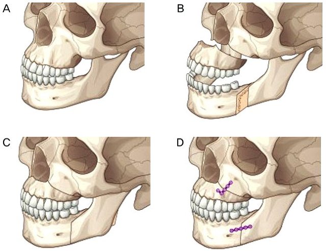 턱수술과 양악수술의 차이.gif | 인스티즈