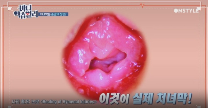 실제 처녀막 사진.jpg | 인스티즈