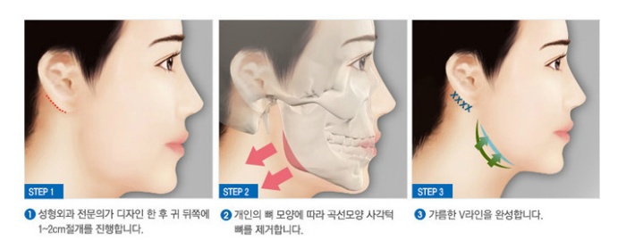 턱수술과 양악수술의 차이.gif | 인스티즈