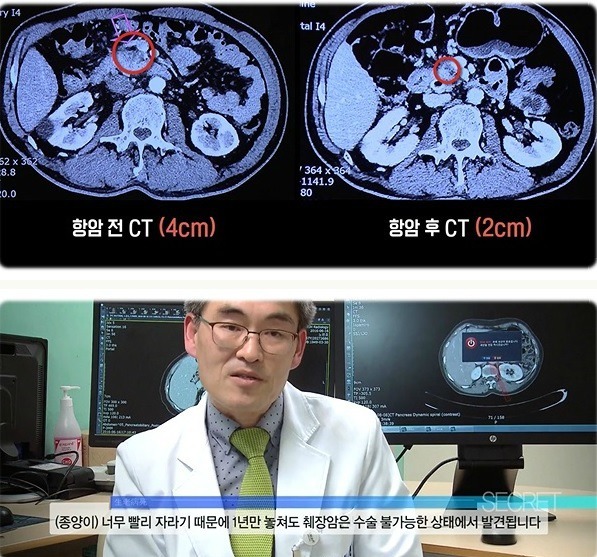 췌장암 검사 꼭 해야 하는 이유 | 인스티즈