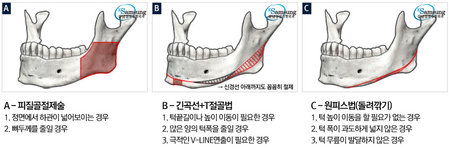 턱수술과 양악수술의 차이.gif | 인스티즈