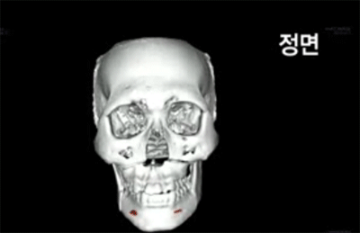 턱수술과 양악수술의 차이.gif | 인스티즈