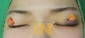 쌍꺼풀 수술은 싫고 눈두덩이가 통통한 사람들이 선호한다는 수술 jpg | 인스티즈