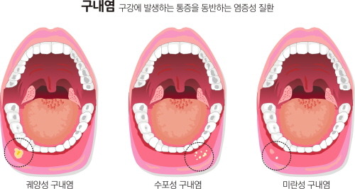군대가면 많이 걸리는 병들 .jpg | 인스티즈