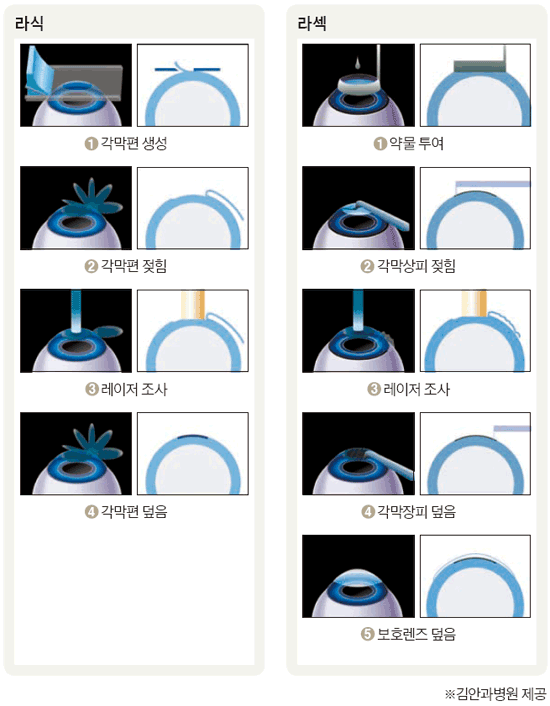 라식수술과 라섹수술의 차이점 | 인스티즈