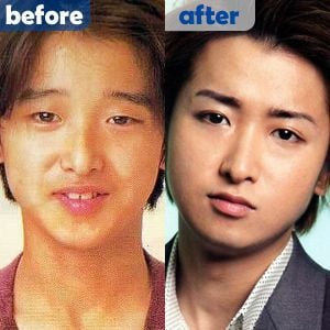 한국이랑은 많이 다른 일본의 성형 트렌드(눈과 코).jpg | 인스티즈