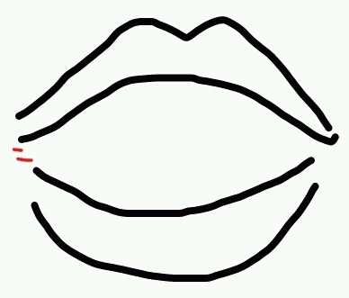 치과에서 사랑니 뽑다가 입 찢어질 뻔 함 | 인스티즈