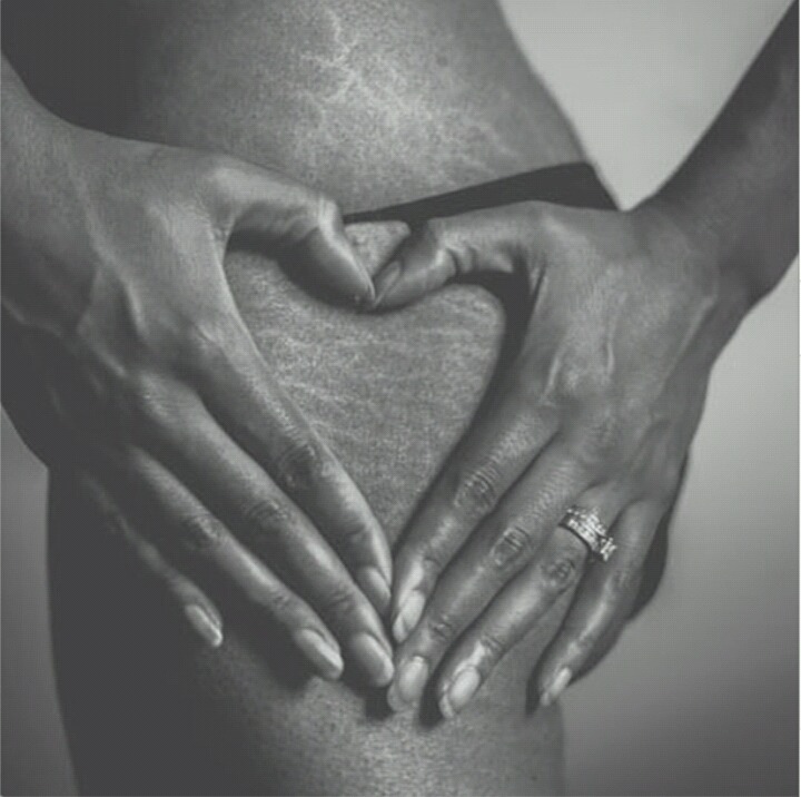 피부 튼살로 고민이 많은 여시들이 봐줬으면 하는 글 | 인스티즈