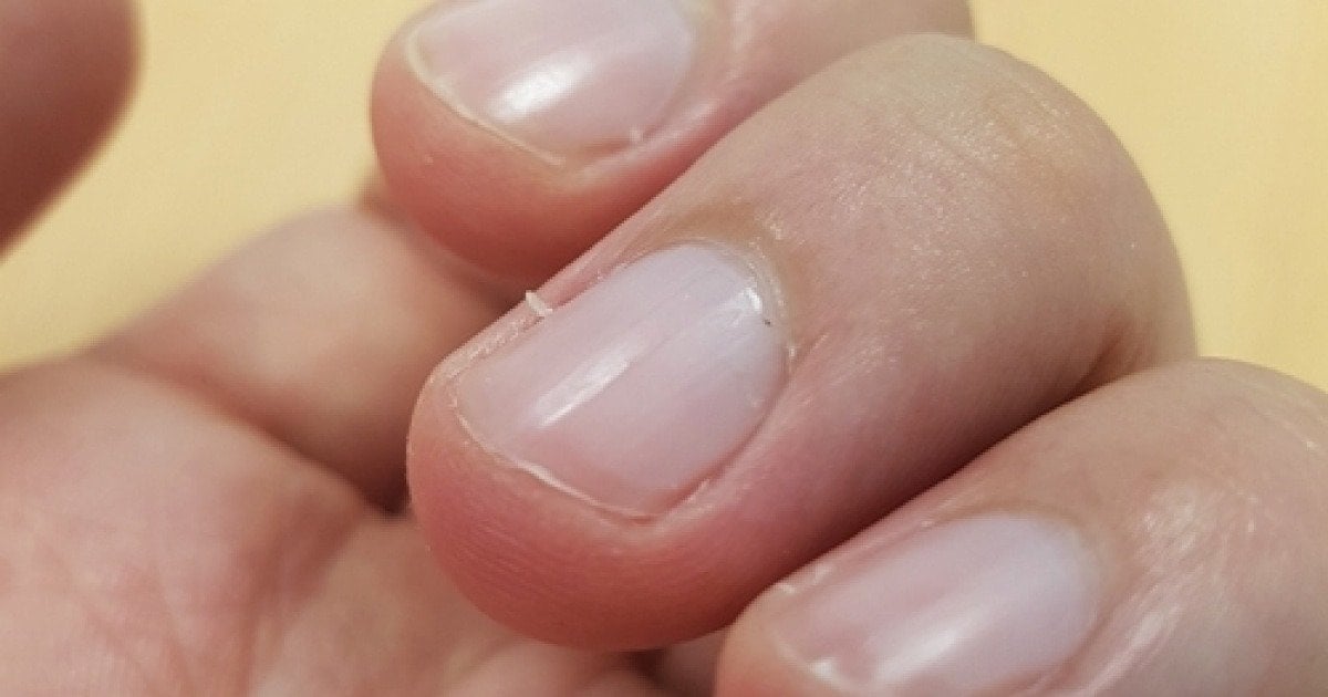 손톱 옆 일어난 살갗, 뜯어내면 안 되는 이유 | 인스티즈