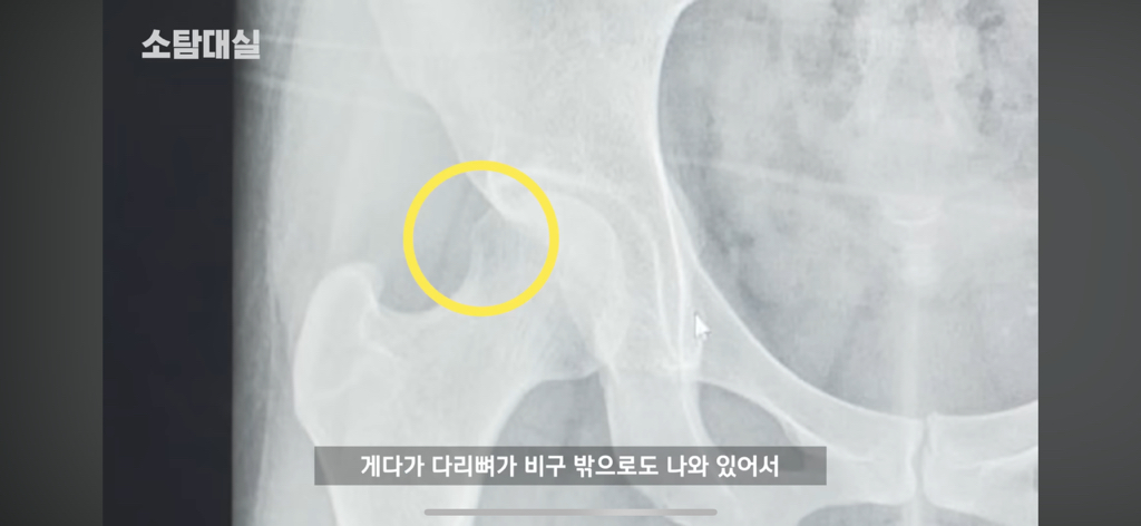 태생부터 다리찢기를 하면 안되는 고관절이 있음 | 인스티즈