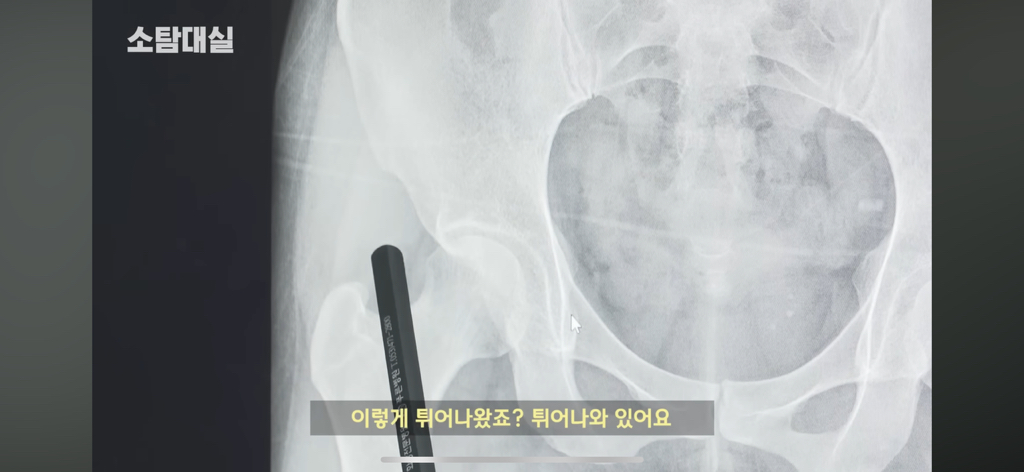 태생부터 다리찢기를 하면 안되는 고관절이 있음 | 인스티즈