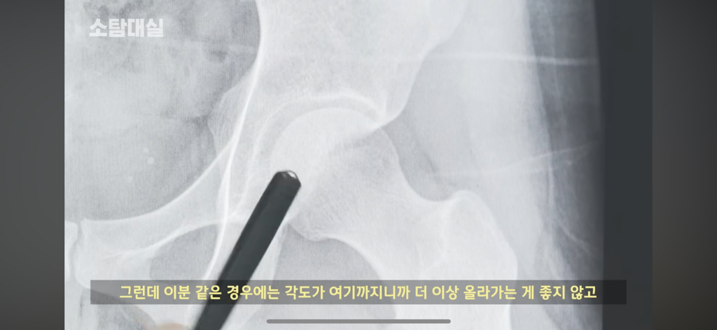 태생부터 다리찢기를 하면 안되는 고관절이 있음 | 인스티즈