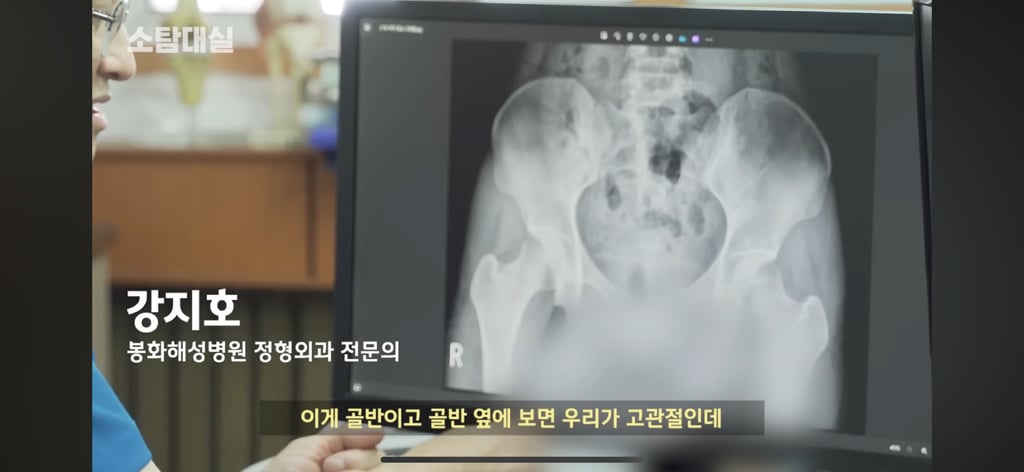 태생부터 다리찢기를 하면 안되는 고관절이 있음 | 인스티즈