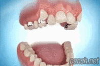 치아 교정원리 .gif | 인스티즈