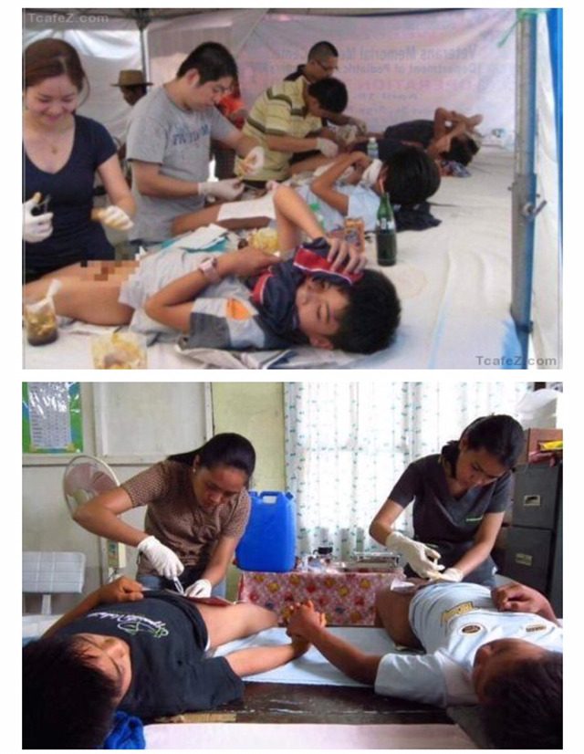 태국의 포경수술 | 인스티즈