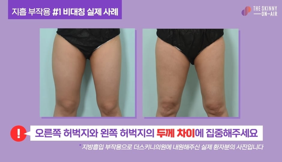 비만클리닉 의사가 지흡을 반대하는 이유.jpg | 인스티즈
