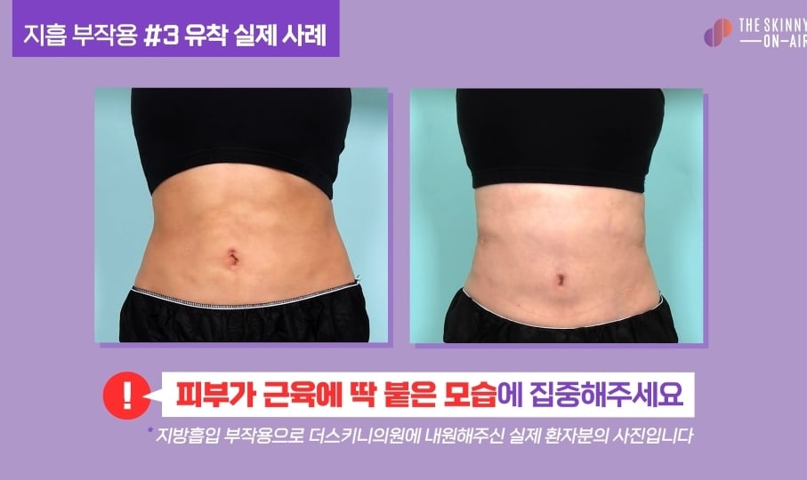 비만클리닉 의사가 지흡을 반대하는 이유.jpg | 인스티즈