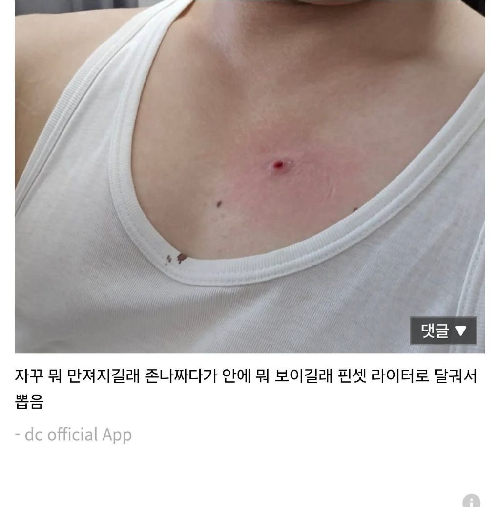 이게 티눈임? | 인스티즈