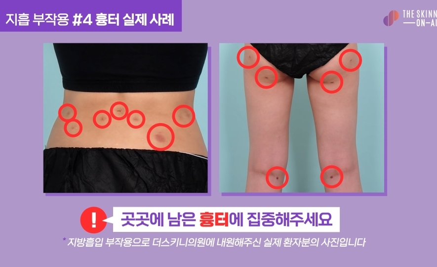 비만클리닉 의사가 지흡을 반대하는 이유.jpg | 인스티즈