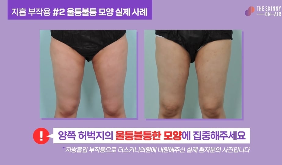 비만클리닉 의사가 지흡을 반대하는 이유.jpg | 인스티즈