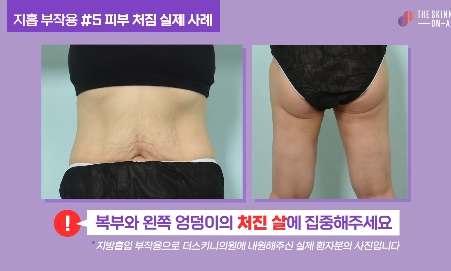 비만클리닉 의사가 지흡을 반대하는 이유.jpg | 인스티즈