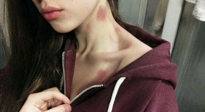 솔로들은 모르는 피부병 | 인스티즈