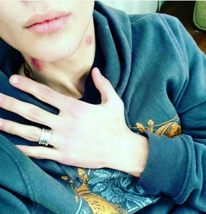 솔로들은 모르는 피부병 | 인스티즈