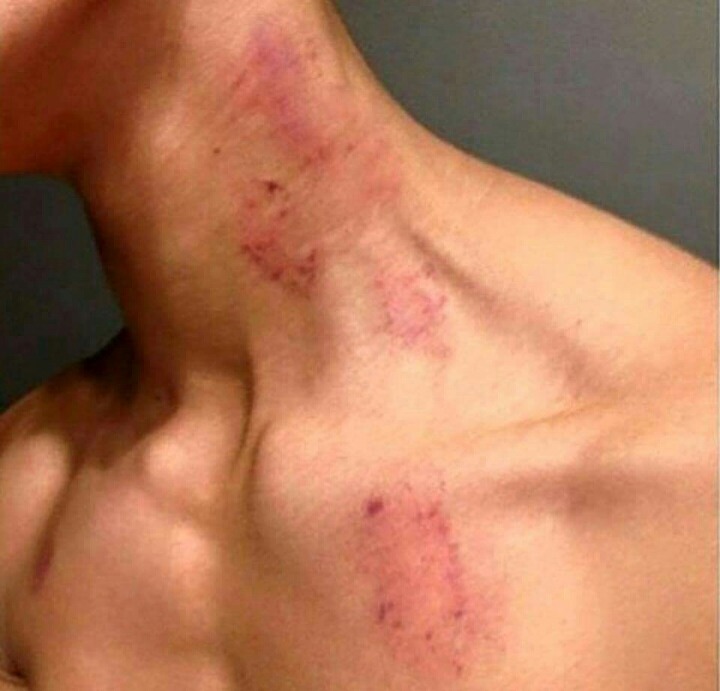 솔로들은 모르는 피부병 | 인스티즈