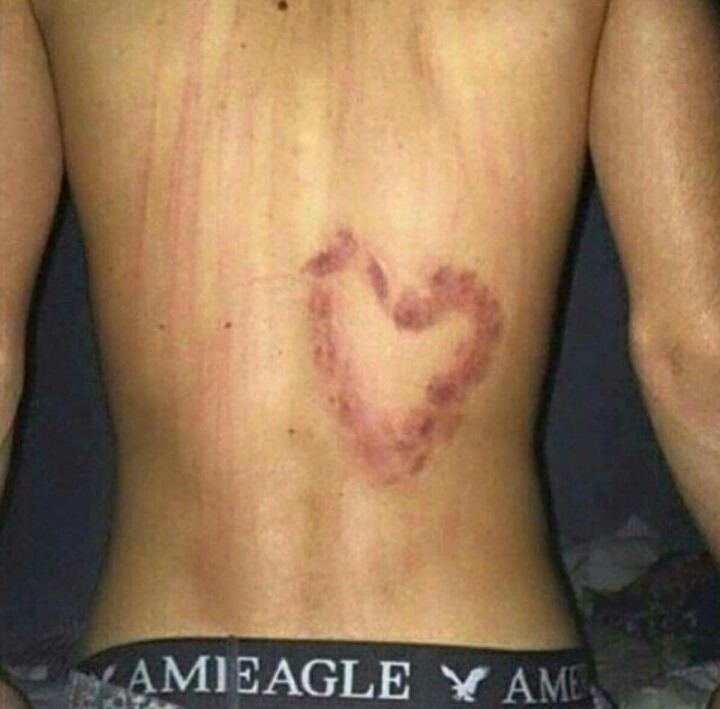 솔로들은 모르는 피부병 | 인스티즈