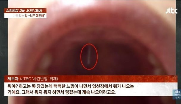 코수술 후 입천장 뚫고 나온 '철심'에 경악…병원 "별거 아냐" | 인스티즈