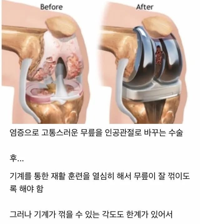 무릎 관리하세요 체질이란게 바뀝니다 | 인스티즈